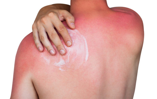 first degree sunburn